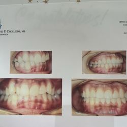 Teeth before and after