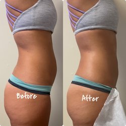 Roxanne Body Sculpting - One session of body sculpting on abdomen.
