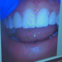 Webster Dental Care North Suburban - Crowns on tooth #7 and #10