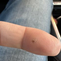 St. Vincent's Urgent Care - Splinter in my finger since about a month. I couldn't get all of it out myself. Painful!