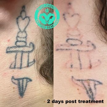 Wise Choice Tattoo Removal - Imagine a future where a single session brings you significantly closer to saying goodbye to your unwanted tattoo. - Tattoo Removal Near Me - Denver, Colorado Wise Choice Tattoo Removal - Imagine a future where a single session brings you significantly closer to saying goodbye to your unwanted tattoo. - Tattoo Removal Near Me - Denver, Colorado