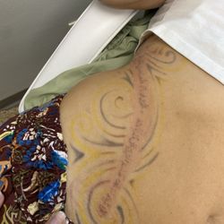 Vanish Laser Services - Immediately after treatment