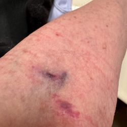 Quest Diagnostics - This is what I was left with after being dug at multiple times, and no, I'm not on blood thinner or aspirin.