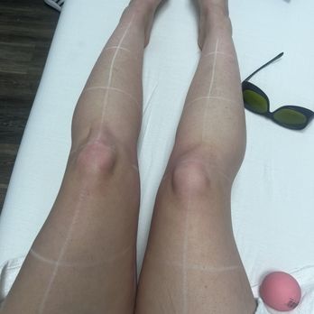 LaserAway - Laser Hair Removal Near Me - Huntington Beach, California LaserAway - Laser Hair Removal Near Me - Huntington Beach, California