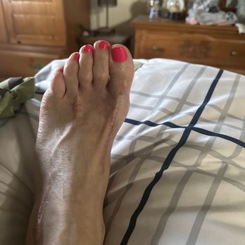 Robert Matteucci, DPM - Scars on ankle and toes. Physical therapist said she never saw post surgery scars like these - Podiatrists Near Me - Franklin, Wisconsin Robert Matteucci, DPM - Scars on ankle and toes. Physical therapist said she never saw post surgery scars like these - Podiatrists Near Me - Franklin, Wisconsin