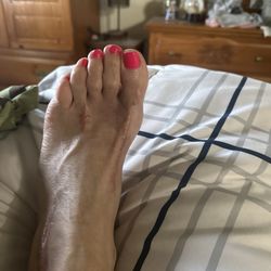 Robert Matteucci, DPM - Scars on ankle and toes. Physical therapist said she never saw post surgery scars like these