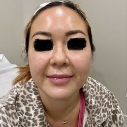 Laser facial Laser facial