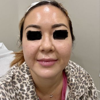 SEV Laser - Laser facial - Laser Hair Removal Near Me - Yorba Linda, California SEV Laser - Laser facial - Laser Hair Removal Near Me - Yorba Linda, California