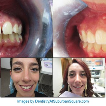 Michael Wollock, DMD- Dentistry At Suburban Square - Real Invisalign® results by Dr. Michael Wollock. See the transformation possible with expert treatment planning and personalized care. - Cosmetic Dentists Near Me - Ardmore, Pennsylvania Michael Wollock, DMD- Dentistry At Suburban Square - Real Invisalign® results by Dr. Michael Wollock. See the transformation possible with expert treatment planning and personalized care. - Cosmetic Dentists Near Me - Ardmore, Pennsylvania