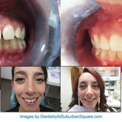 Dentistry At Suburban Square: Michael I. Wollock, DMD - Real Invisalign® results by Dr. Michael Wollock. See the transformation possible with expert treatment planning and personalized care.