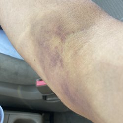 CSL Plasma - My arm got ravaged by  unskilled technicians here