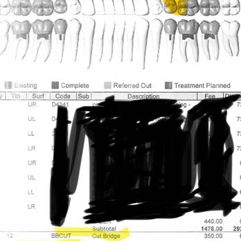 Upland Dental Practice - 2 months after 2nd opinion of anotherd dentist. The yellow are the ones Salami did. Tooth 20,13,14. - Pediatric Dentists Near Me - Upland, California