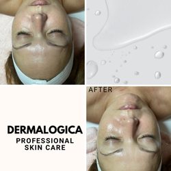 Before and After 1 service using dermalogica professional skincare