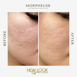 New Look Skin Center - Morpheus8 (1 Treatment)