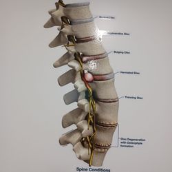 BioSpine Institute - Different spine problems