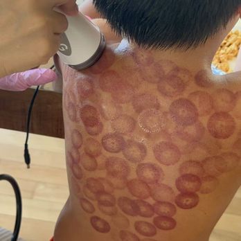 Red Cupping Clinic - Cupping in action! - Massage Therapy Near Me - Redmond, Washington Red Cupping Clinic - Cupping in action! - Massage Therapy Near Me - Redmond, Washington