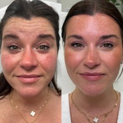 Botox with Courtney Cox