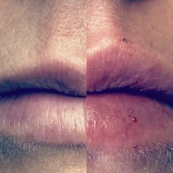 Elle Aesthetics - 1 cc of Revanesse HA Filler--slight plumping--as requested by client.