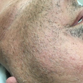 Stripped Body Bar - Before - Male Full Face Wax - Hair Removal Near Me - Spring, Texas Stripped Body Bar - Before - Male Full Face Wax - Hair Removal Near Me - Spring, Texas