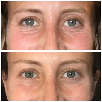 Elevare MD - Before - top photo 2 weeks later - bottom photo - Skin Care Near Me - Chicago, Illinois