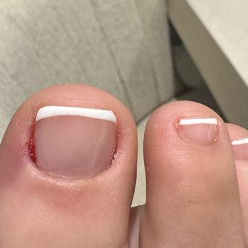 New Schibolo Nails - Infection after they cut too much. - Nail Salons Near Me - New Braunfels, Texas New Schibolo Nails - Infection after they cut too much. - Nail Salons Near Me - New Braunfels, Texas