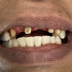 Genesis Dental Esthetics - Multiple missing teeth.