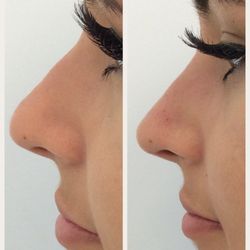 Wellness Center of Greater Cleveland - Non surgical rhinoplasty