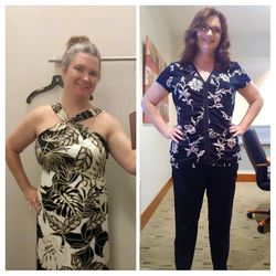 Inspire Medical - Before and after