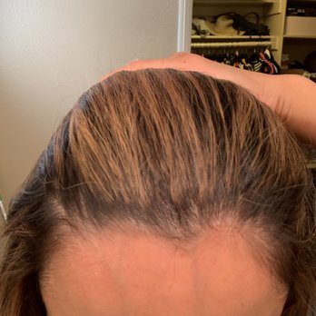 Union Salon - All the breakage has left my hairline with bald spots and my scalp raw and peeling - Hair Salons Near Me - Pasadena, California Union Salon - All the breakage has left my hairline with bald spots and my scalp raw and peeling - Hair Salons Near Me - Pasadena, California