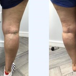 Vein Specialist Centers - Great Neck NY - Spider Vein Treatment