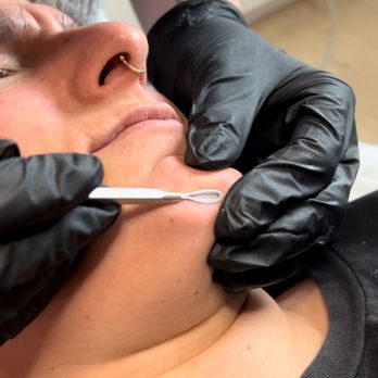 Foxy Laser - Extractions - Medical Spas Near Me - Denver, Colorado