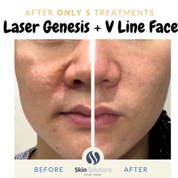 Skin Solutions - Laser Genesis and V Line Face Lifting for younger and healthy skin in only 5 skin treatments - Skin Care Near Me - Flushing, New York Skin Solutions - Laser Genesis and V Line Face Lifting for younger and healthy skin in only 5 skin treatments - Skin Care Near Me - Flushing, New York