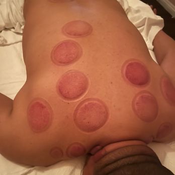 Sun Massage - After cups removed - Massage Near Me - Los Angeles, California Sun Massage - After cups removed - Massage Near Me - Los Angeles, California