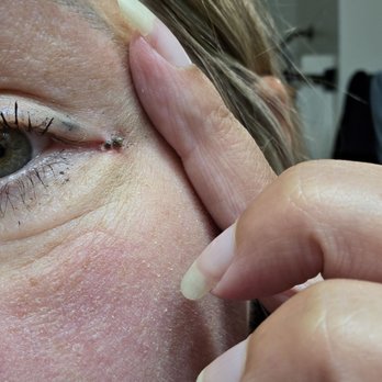 Bright Eyes MD - New undereye crease & internal sutures protruding out by my left eye - Cosmetic Surgeons Near Me - San Diego, California