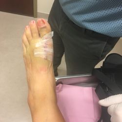 Vittorio Lagana, DPM - 4.5 days post op