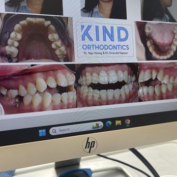 Kind Orthodontics - Before - Orthodontists Near Me - Hayward, California