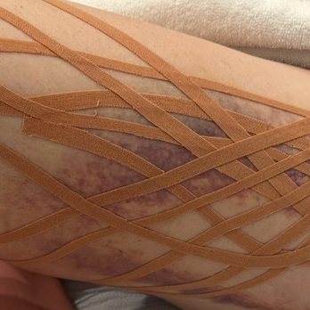 Chic la Vie Med Spa - Kinesiology Tape technique! Can help with bruising and swelling - Skin Care Near Me - Las Vegas, Nevada Chic la Vie Med Spa - Kinesiology Tape technique! Can help with bruising and swelling - Skin Care Near Me - Las Vegas, Nevada
