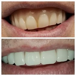 Celella Stephen, DDS - I fabricated a new removable full denture