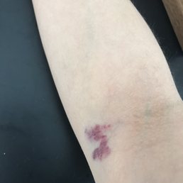 Bruised arm after blood drawn.