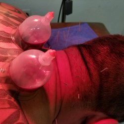 Jun Acupuncture - Wet cupping on two old knots in my rhomboids