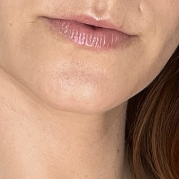 Snatched Beverly Hills - before any filler - Medical Spas Near Me - Beverly Hills, California Snatched Beverly Hills - before any filler - Medical Spas Near Me - Beverly Hills, California