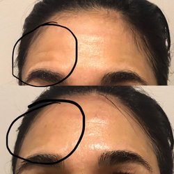 Aum Aesthetics Medical Spa - RF skin tightening treatment before and after