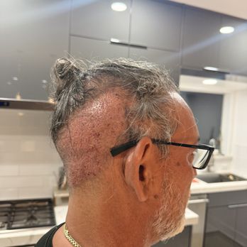 Medical Mex - Photo taken after my procedure showing the result. This outcome does not match the procedure I was promised and paid for. - Plastic Surgeons Near Me