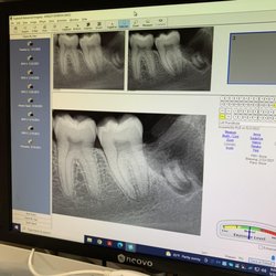 Peak Dental - Socket with part of a tooth and exposed nerves left behind