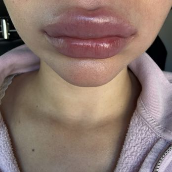 OVME - Dissolving the filler that OVME messed up - Skin Care Near Me - Charlotte, North Carolina OVME - Dissolving the filler that OVME messed up - Skin Care Near Me - Charlotte, North Carolina
