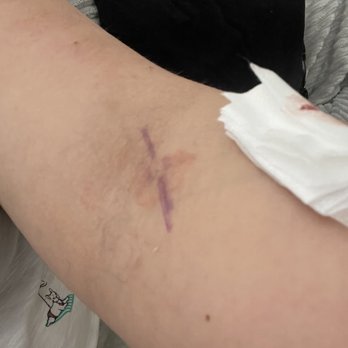 American Red Cross - How she left my left arm. - Blood & Plasma Donation Centers Near Me - Stockton, California American Red Cross - How she left my left arm. - Blood & Plasma Donation Centers Near Me - Stockton, California