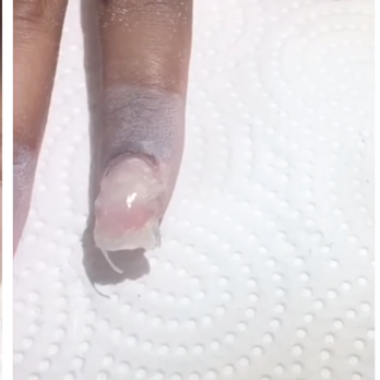 Shadow Nails - Photo from online sources, My nail looked EXACTLY like this when I tried to remove. EMA should not look like this - Nail Salons Near Me - Seattle, Washington