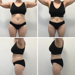 Weight Loss Shots