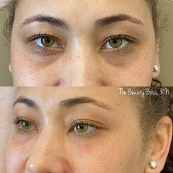 The Beauty Joint - Tear Trough Filler - Medical Spas Near Me - Gilbert, Arizona The Beauty Joint - Tear Trough Filler - Medical Spas Near Me - Gilbert, Arizona