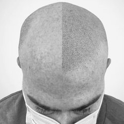 Vivid Cosmetic Studio - SMP Before & After